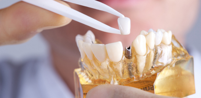 dental implants cost