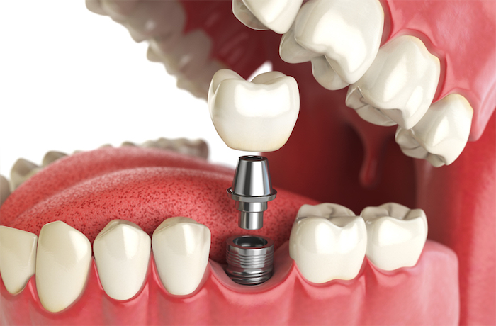 Recurrent Pericoronitis teeth