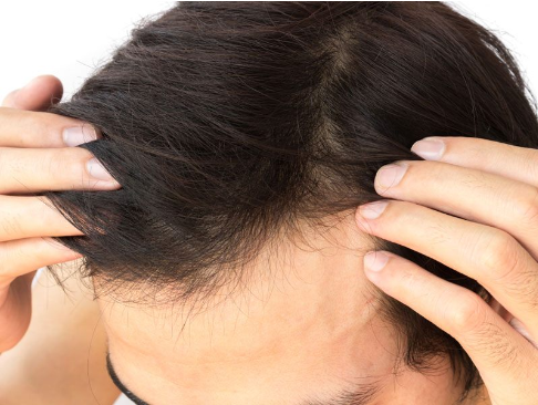 PRP Hair Loss