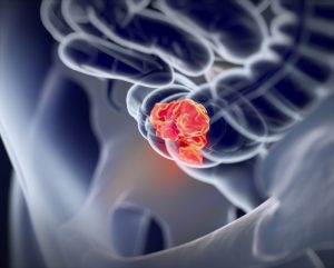 Colon Cancer