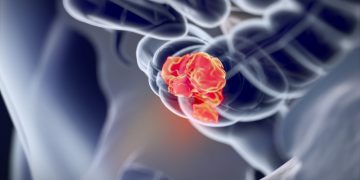 Colon Cancer