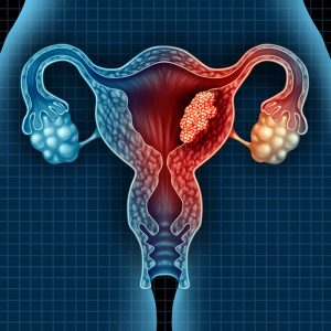 Treat Uterine Fibroids