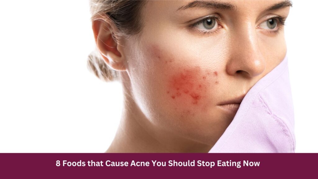 8 Foods that Cause Acne You Should Stop Eating Now