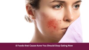 8 Foods that Cause Acne You Should Stop Eating Now
