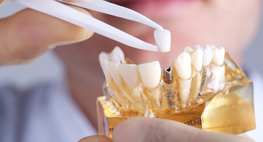 How Dental Implants Are Valuable Options For You