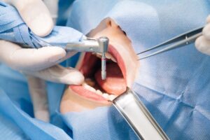 dental+implants+Adelaide
