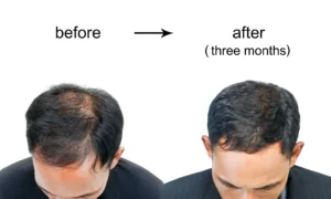 Best-Hair-Loss-Treatments-for-Men