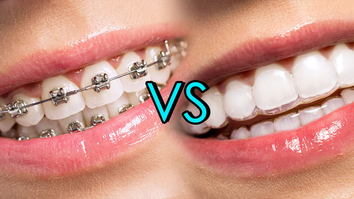 Braces
