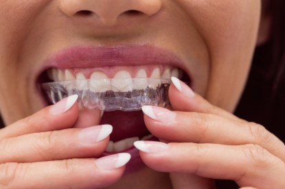 A Guide to Clear Aligners