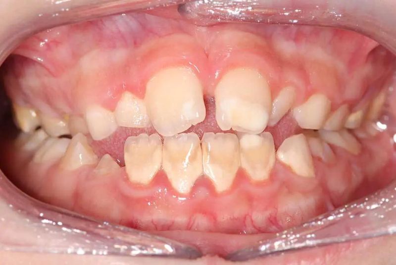 Identifying Malocclusion in Children and Adolescents  