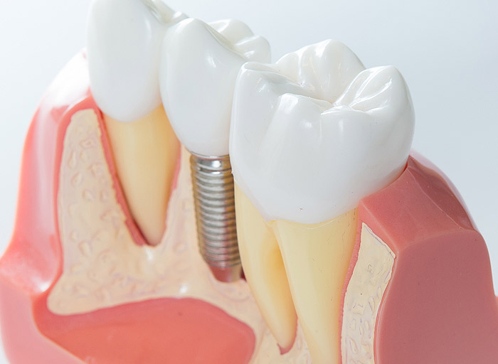 Bone-Grafting