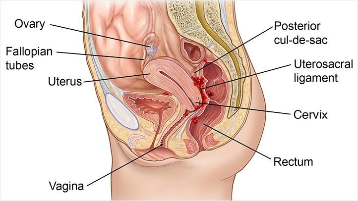Endometriosis and Its Impact on Vaginal Health