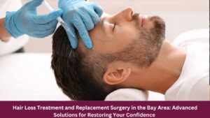 Hair Loss Treatment and Replacement Surgery in the Bay Area: Advanced Solutions for Restoring Your Confidence