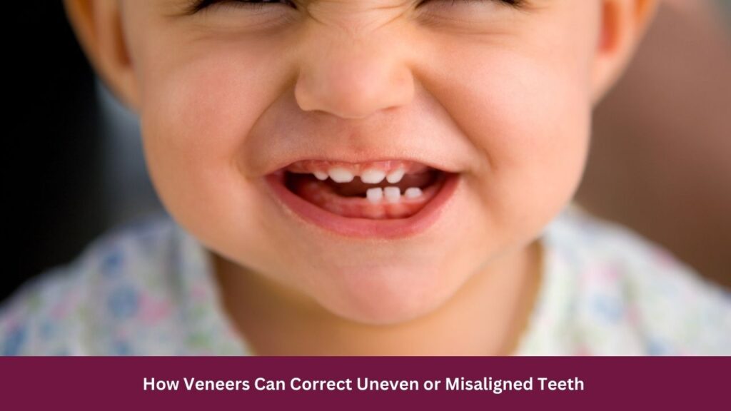 How Veneers Can Correct Uneven or Misaligned Teeth