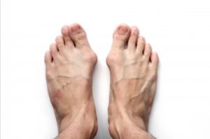 Consult a podiatrist for tailor's bunion