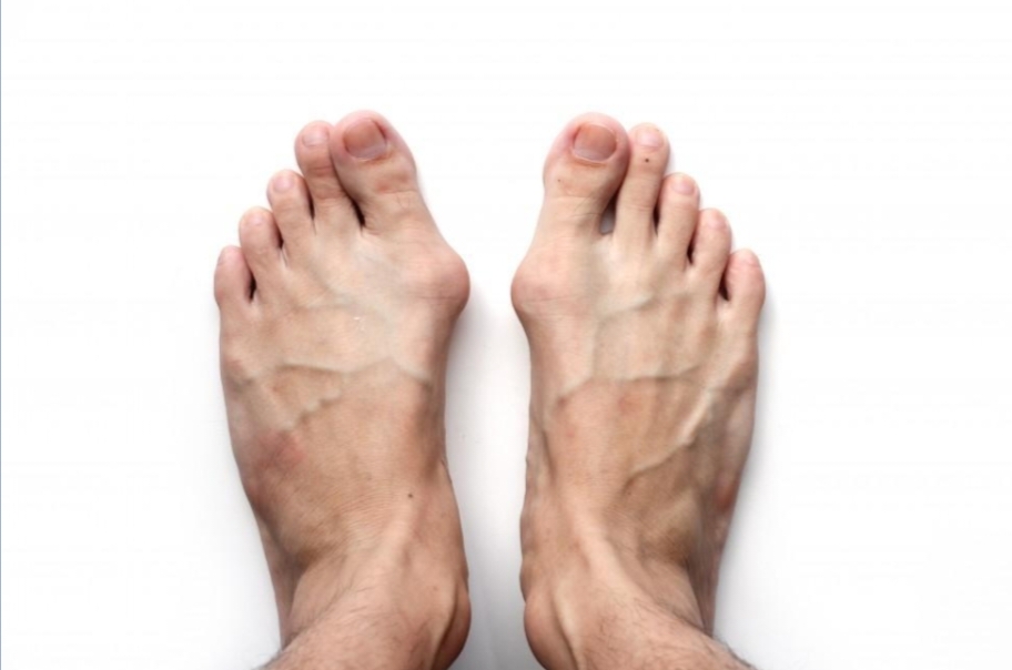 Consult a podiatrist for tailor's bunion