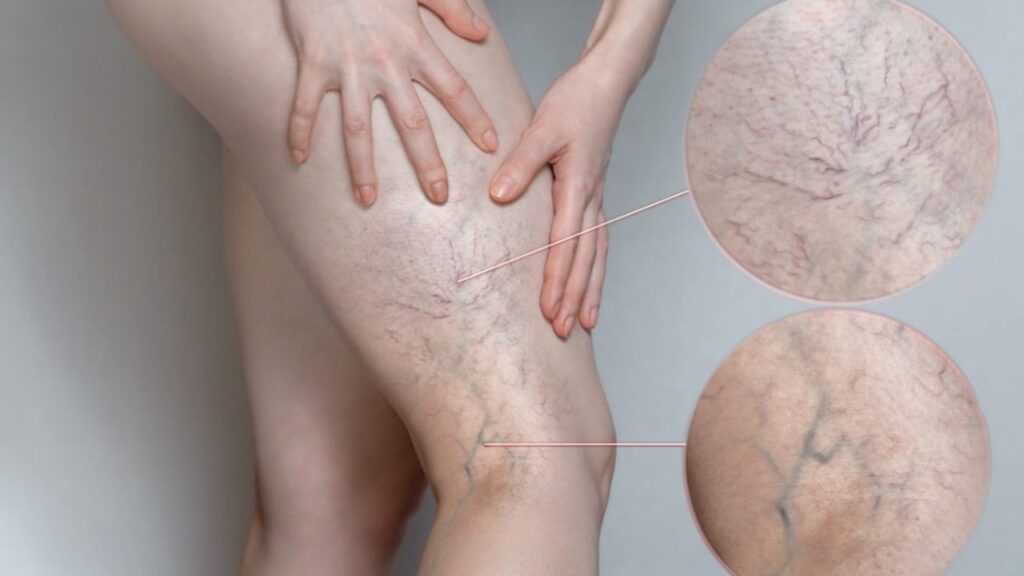 "Spider Veins Natural Treatment: Simple Remedies and Lifestyle Tips for Relief" Spider veins are small, twisted veins that often appear on the legs or face, looking like thin webs of red, blue, or purple lines. I first noticed them in my late twenties after long hours of sitting at a desk. Over time, I realized they were more common than I thought, especially in people who stand or sit for extended periods. These veins don’t usually cause pain, but they can affect confidence and how you feel about your skin. Many people, including myself, turn to natural treatment options instead of medical procedures. Not only are these gentle on the body, but they’re also affordable and easy to try at home. Over the years, I’ve found that combining simple lifestyle changes with spider veins natural remedies made a noticeable difference. If you're looking for a safe and effective way to deal with this issue, natural methods can offer real relief without harsh side effects. What are Spider Veins? Spider veins are tiny, visible blood vessels that appear just under the skin, often in red, blue, or purple colors. They usually show up on the legs or face and look like thin branches or webs. While they’re usually harmless, they can be a cosmetic concern for many people. I started noticing them after years of standing for long hours at work, which made me look into natural treatment options. Taking early steps can really help manage their appearance. Why Consider Natural Treatments For Spider Vein? Using a spider veins natural treatment is a great choice if you prefer safer and more affordable options. When I first started noticing mine, I wasn’t ready for medical procedures, so I tried natural methods like essential oils, herbal creams, and regular leg elevation. These gentle approaches helped improve my circulation and reduced the visible veins over time. Natural treatments work slowly but support long-term skin and vein health. They’re also free from harsh chemicals, making them ideal for people with sensitive skin like mine. Causes of Spider Veins Poor circulation: from sitting or standing too long — I noticed mine got worse during long work hours. Hormonal changes: during pregnancy, menopause, or due to birth control — a big trigger in my case. Genetics: if your parents had spider veins, you’re more likely to get them too. Age: as we get older, vein walls weaken and can lead to visible veins. Lack of movement or exercise: this slows blood flow and puts more pressure on veins.. Effective Natural Treatments for Spider Veins Herbal Remedies Here are some of the herbal remedies that worked for me when dealing with spider veins natural treatment: Horse chestnut extract: Known for strengthening veins, it’s one of the most popular remedies. I’ve used it both in cream form and as a supplement to improve circulation and reduce swelling. Butcher’s broom: This herb helps reduce inflammation and enhances blood flow, making it easier to manage the appearance of spider veins. I often use it as a cream or in capsules. Grape seed extract: Rich in antioxidants, it supports vein health and reduces the visibility of spider veins. I take it in supplement form and have noticed its benefits over time. These herbal remedies have been a gentle yet effective part of my journey with spider veins, providing relief without harsh chemicals. Essential Oils Essential oils have been a simple yet powerful part of my natural treatment routine for spider veins. Here are the ones that have worked best near for me: Cypress oil: This oil stimulates blood flow and strengthens veins, making it one of my go-to remedies. I massage it into the affected area, and it helps reduce the appearance of spider veins. Lavender oil: Known for its calming properties, it not only helps with stress but also improves circulation. I mix a few drops with a carrier oil and gently massage it in for relief. Chamomile oil: This soothing oil reduces inflammation and helps calm the skin, especially after a long day. It’s been a helpful addition to my spider veins care routine. Using essential oils in my daily skincare routine has not only helped with the veins but also left my skin feeling refreshed and relaxed. Lifestyle Changes to Prevent and Treat Spider Veins Naturally Here are some lifestyle changes that have helped me manage and prevent spider veins naturally: Exercise regularly: Staying active, especially with walking or swimming, boosts circulation and strengthens veins. I noticed a difference in the appearance of my veins after adding regular leg exercises to my routine. Maintain a healthy weight: Carrying excess weight can put extra pressure on your veins. Keeping a balanced diet has helped me reduce strain on my veins and prevent new ones from forming. Avoid standing or sitting for long periods: I make it a point to take breaks throughout the day, either by walking around or elevating my legs. This keeps the blood flowing and reduces pressure on the veins. Wear compression stockings: These helped me by providing gentle pressure that supports circulation, especially on long days when I'm standing or sitting for hours. Making these lifestyle changes has been a simple yet effective way to keep my spider veins in check, and it’s something I now make a priority every day. Home Remedies and DIY Treatments For Spider Veins Natural Treatment Here are some home remedies and DIY treatments that I’ve found helpful for spider veins: Apple cider vinegar: I apply it directly to my veins with a cotton ball. It helps improve blood flow and tightens the skin, which reduces the appearance of spider veins over time. Witch hazel: Known for its anti-inflammatory properties, I use it as a toner or apply it directly to my legs. It helps soothe the skin and reduce any swelling. Cold compresses: I often use a cold compress on my legs after a long day. The cold helps reduce swelling and improves circulation by constricting the veins temporarily. Epsom salt bath: Soaking in warm water with Epsom salt has been incredibly relaxing. It reduces inflammation and soothes tired legs, promoting better circulation. These DIY treatments have been a natural and affordable way for me to manage spider veins while avoiding harsh chemicals or expensive treatments. When to Seek Medical Advice For Spider Veins Natural Treatment It’s important to know when to seek medical advice for spider veins, especially if you’re trying natural treatments but don’t see improvement. Here are some signs I learned to watch out for: Pain or discomfort: If your spider veins start to hurt or become swollen, it may be a sign that the condition is worsening. Bleeding: If the veins start to bleed, it's essential to see a doctor immediately. Changes in skin color: If the skin around the veins turns dark or inflamed, it could indicate a more serious issue. Open sores or ulcers: If you notice sores developing near the veins, it’s best to consult a healthcare professional. Persistent or worsening symptoms: If spider veins keep appearing or worsen despite trying natural remedies, a doctor can help explore medical options. Conclusion When dealing with spider veins, I’ve found that natural treatments can be both effective and gentle on the body. Remedies like apple cider vinegar, cypress essential oil, and horse chestnut extract can help improve circulation and reduce the appearance of veins without harsh chemicals. Making simple lifestyle changes such as exercising regularly, maintaining a healthy weight, and elevating your legs also plays a big role in preventing and treating spider veins naturally. While results may take time, sticking with these natural methods can lead to long-term improvements and healthier-looking skin. If symptoms persist or worsen, however, it’s important to seek medical advice to ensure proper care.