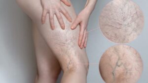 "Spider Veins Natural Treatment: Simple Remedies and Lifestyle Tips for Relief" Spider veins are small, twisted veins that often appear on the legs or face, looking like thin webs of red, blue, or purple lines. I first noticed them in my late twenties after long hours of sitting at a desk. Over time, I realized they were more common than I thought, especially in people who stand or sit for extended periods. These veins don’t usually cause pain, but they can affect confidence and how you feel about your skin. Many people, including myself, turn to natural treatment options instead of medical procedures. Not only are these gentle on the body, but they’re also affordable and easy to try at home. Over the years, I’ve found that combining simple lifestyle changes with spider veins natural remedies made a noticeable difference. If you're looking for a safe and effective way to deal with this issue, natural methods can offer real relief without harsh side effects. What are Spider Veins? Spider veins are tiny, visible blood vessels that appear just under the skin, often in red, blue, or purple colors. They usually show up on the legs or face and look like thin branches or webs. While they’re usually harmless, they can be a cosmetic concern for many people. I started noticing them after years of standing for long hours at work, which made me look into natural treatment options. Taking early steps can really help manage their appearance. Why Consider Natural Treatments For Spider Vein? Using a spider veins natural treatment is a great choice if you prefer safer and more affordable options. When I first started noticing mine, I wasn’t ready for medical procedures, so I tried natural methods like essential oils, herbal creams, and regular leg elevation. These gentle approaches helped improve my circulation and reduced the visible veins over time. Natural treatments work slowly but support long-term skin and vein health. They’re also free from harsh chemicals, making them ideal for people with sensitive skin like mine. Causes of Spider Veins Poor circulation: from sitting or standing too long — I noticed mine got worse during long work hours. Hormonal changes: during pregnancy, menopause, or due to birth control — a big trigger in my case. Genetics: if your parents had spider veins, you’re more likely to get them too. Age: as we get older, vein walls weaken and can lead to visible veins. Lack of movement or exercise: this slows blood flow and puts more pressure on veins.. Effective Natural Treatments for Spider Veins Herbal Remedies Here are some of the herbal remedies that worked for me when dealing with spider veins natural treatment: Horse chestnut extract: Known for strengthening veins, it’s one of the most popular remedies. I’ve used it both in cream form and as a supplement to improve circulation and reduce swelling. Butcher’s broom: This herb helps reduce inflammation and enhances blood flow, making it easier to manage the appearance of spider veins. I often use it as a cream or in capsules. Grape seed extract: Rich in antioxidants, it supports vein health and reduces the visibility of spider veins. I take it in supplement form and have noticed its benefits over time. These herbal remedies have been a gentle yet effective part of my journey with spider veins, providing relief without harsh chemicals. Essential Oils Essential oils have been a simple yet powerful part of my natural treatment routine for spider veins. Here are the ones that have worked best near for me: Cypress oil: This oil stimulates blood flow and strengthens veins, making it one of my go-to remedies. I massage it into the affected area, and it helps reduce the appearance of spider veins. Lavender oil: Known for its calming properties, it not only helps with stress but also improves circulation. I mix a few drops with a carrier oil and gently massage it in for relief. Chamomile oil: This soothing oil reduces inflammation and helps calm the skin, especially after a long day. It’s been a helpful addition to my spider veins care routine. Using essential oils in my daily skincare routine has not only helped with the veins but also left my skin feeling refreshed and relaxed. Lifestyle Changes to Prevent and Treat Spider Veins Naturally Here are some lifestyle changes that have helped me manage and prevent spider veins naturally: Exercise regularly: Staying active, especially with walking or swimming, boosts circulation and strengthens veins. I noticed a difference in the appearance of my veins after adding regular leg exercises to my routine. Maintain a healthy weight: Carrying excess weight can put extra pressure on your veins. Keeping a balanced diet has helped me reduce strain on my veins and prevent new ones from forming. Avoid standing or sitting for long periods: I make it a point to take breaks throughout the day, either by walking around or elevating my legs. This keeps the blood flowing and reduces pressure on the veins. Wear compression stockings: These helped me by providing gentle pressure that supports circulation, especially on long days when I'm standing or sitting for hours. Making these lifestyle changes has been a simple yet effective way to keep my spider veins in check, and it’s something I now make a priority every day. Home Remedies and DIY Treatments For Spider Veins Natural Treatment Here are some home remedies and DIY treatments that I’ve found helpful for spider veins: Apple cider vinegar: I apply it directly to my veins with a cotton ball. It helps improve blood flow and tightens the skin, which reduces the appearance of spider veins over time. Witch hazel: Known for its anti-inflammatory properties, I use it as a toner or apply it directly to my legs. It helps soothe the skin and reduce any swelling. Cold compresses: I often use a cold compress on my legs after a long day. The cold helps reduce swelling and improves circulation by constricting the veins temporarily. Epsom salt bath: Soaking in warm water with Epsom salt has been incredibly relaxing. It reduces inflammation and soothes tired legs, promoting better circulation. These DIY treatments have been a natural and affordable way for me to manage spider veins while avoiding harsh chemicals or expensive treatments. When to Seek Medical Advice For Spider Veins Natural Treatment It’s important to know when to seek medical advice for spider veins, especially if you’re trying natural treatments but don’t see improvement. Here are some signs I learned to watch out for: Pain or discomfort: If your spider veins start to hurt or become swollen, it may be a sign that the condition is worsening. Bleeding: If the veins start to bleed, it's essential to see a doctor immediately. Changes in skin color: If the skin around the veins turns dark or inflamed, it could indicate a more serious issue. Open sores or ulcers: If you notice sores developing near the veins, it’s best to consult a healthcare professional. Persistent or worsening symptoms: If spider veins keep appearing or worsen despite trying natural remedies, a doctor can help explore medical options. Conclusion When dealing with spider veins, I’ve found that natural treatments can be both effective and gentle on the body. Remedies like apple cider vinegar, cypress essential oil, and horse chestnut extract can help improve circulation and reduce the appearance of veins without harsh chemicals. Making simple lifestyle changes such as exercising regularly, maintaining a healthy weight, and elevating your legs also plays a big role in preventing and treating spider veins naturally. While results may take time, sticking with these natural methods can lead to long-term improvements and healthier-looking skin. If symptoms persist or worsen, however, it’s important to seek medical advice to ensure proper care.