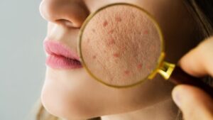 Face Wash for Oily Skin and Pimples