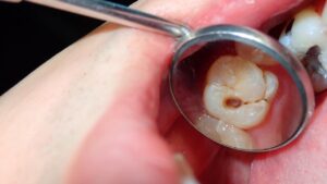 Prevent Tooth Decay