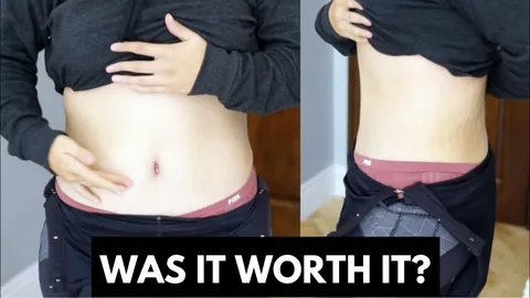 Tummy Tuck Surgery