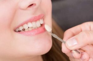 Veneers