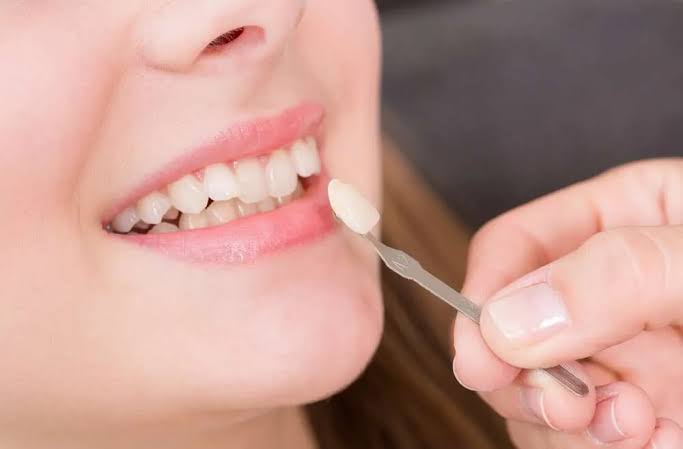 Veneers