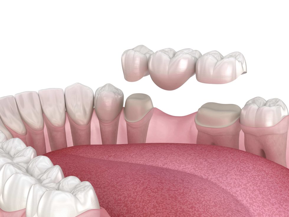 Dental Crown