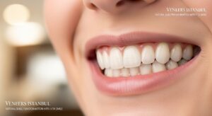Veneers Istanbul | Natural Smile Transformation with Vita Smile