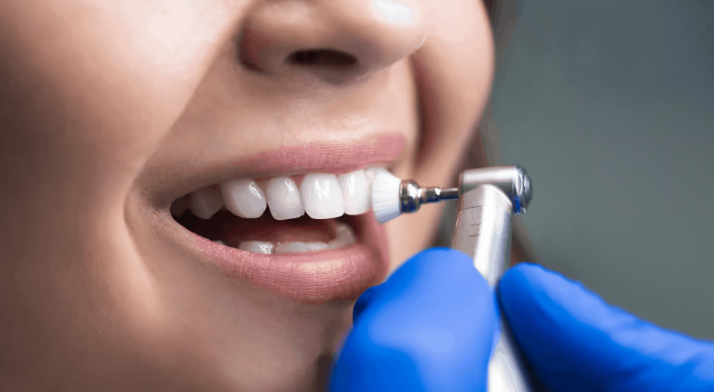 Ways Porcelain Veneers in London Outshine