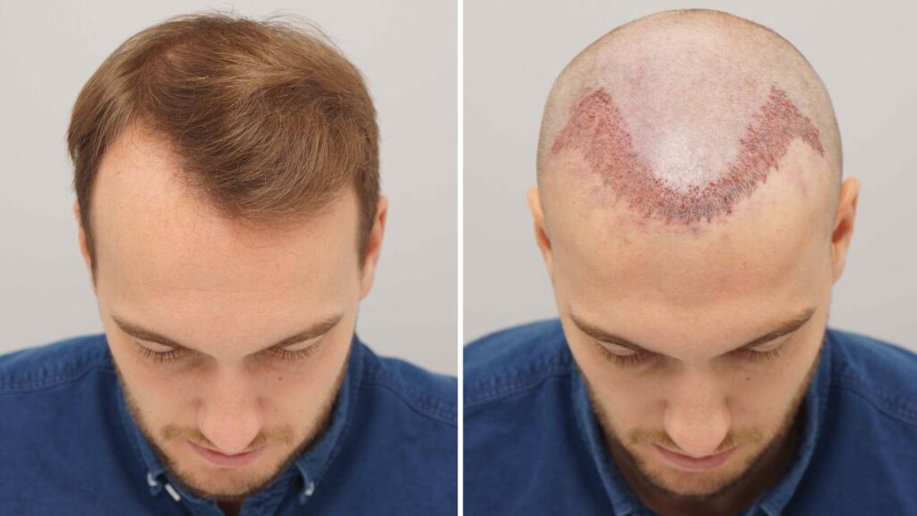 Hair Transplant