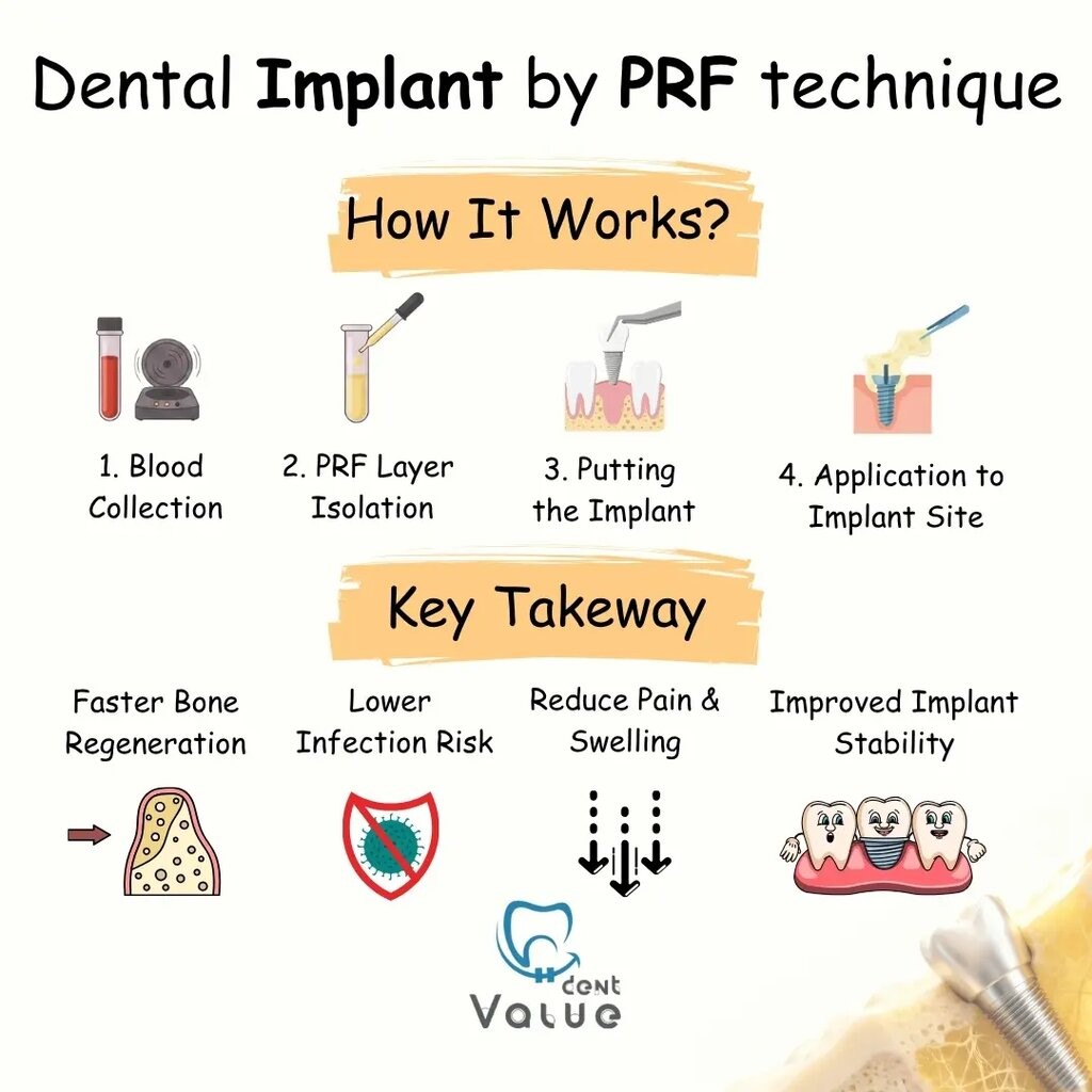 PRF-Dental-Implants