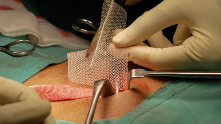 hernia surgery in Brisbane