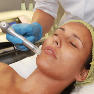 Microneedling