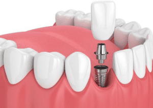Benefits Of Choosing Implants Over Traditional Restorations