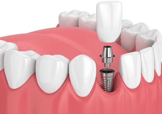 Benefits Of Choosing Implants Over Traditional Restorations