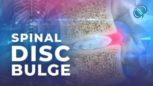 Bulging Discs in Sugar Land